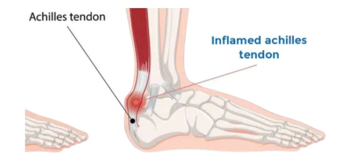 Achilles Tendonitis